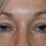 Blepharoplasty Before & After Patient #25022