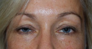 Blepharoplasty Before & After Patient #25022