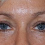 Blepharoplasty Before & After Patient #25022