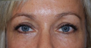 Blepharoplasty Before & After Patient #25022