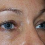 Blepharoplasty Before & After Patient #25022