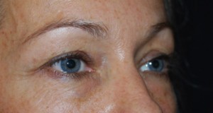 Blepharoplasty Before & After Patient #25022