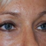 Blepharoplasty Before & After Patient #25022