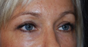 Blepharoplasty Before & After Patient #25022