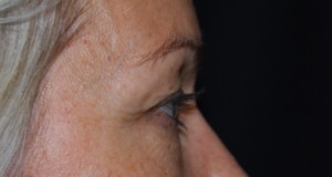 Blepharoplasty Before & After Patient #25022