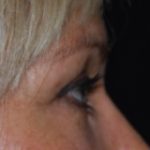 Blepharoplasty Before & After Patient #25022
