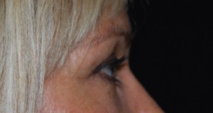 Blepharoplasty Before & After Patient #25022