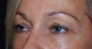 Blepharoplasty Before & After Patient #25022