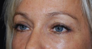 Blepharoplasty Before & After Patient #25022