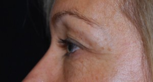 Blepharoplasty Before & After Patient #25022