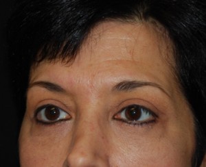 Blepharoplasty Before & After Patient #25043