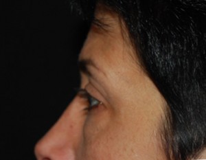 Blepharoplasty Before & After Patient #25043