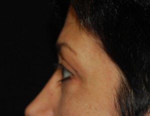 Blepharoplasty Before & After Patient #25043