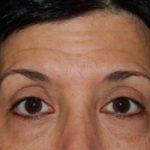 Blepharoplasty Before & After Patient #25043