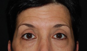 Blepharoplasty Before & After Patient #25043