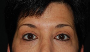 Blepharoplasty Before & After Patient #25043