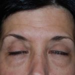 Blepharoplasty Before & After Patient #25043