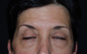 Blepharoplasty Before & After Patient #25043
