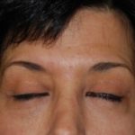 Blepharoplasty Before & After Patient #25043