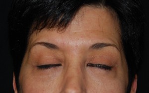 Blepharoplasty Before & After Patient #25043