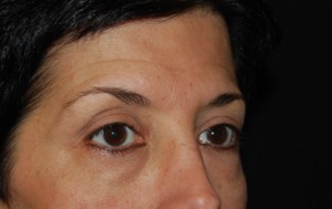 Blepharoplasty Before & After Patient #25043