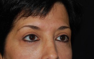 Blepharoplasty Before & After Patient #25043