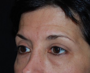 Blepharoplasty Before & After Patient #25043