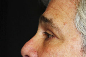 Blepharoplasty Before & After Patient #25045