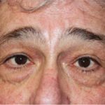 Blepharoplasty Before & After Patient #25045