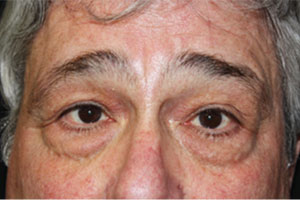 Blepharoplasty Before & After Patient #25045