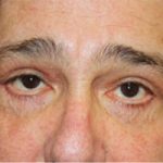 Blepharoplasty Before & After Patient #25045