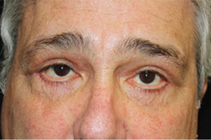 Blepharoplasty Before & After Patient #25045