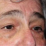 Blepharoplasty Before & After Patient #25045