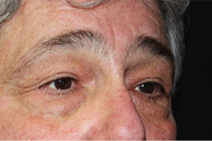 Blepharoplasty Before & After Patient #25045