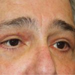 Blepharoplasty Before & After Patient #25045