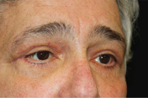 Blepharoplasty Before & After Patient #25045