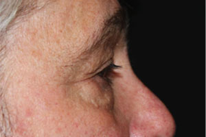 Blepharoplasty Before & After Patient #25045