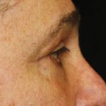 Blepharoplasty Before & After Patient #25045