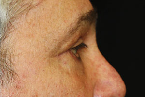 Blepharoplasty Before & After Patient #25045