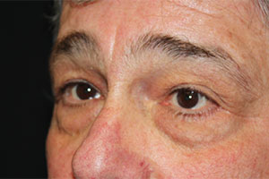 Blepharoplasty Before & After Patient #25045