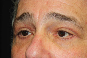 Blepharoplasty Before & After Patient #25045