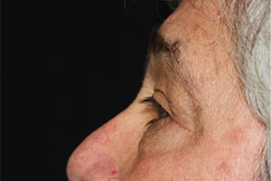 Blepharoplasty Before & After Patient #25045