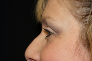 Blepharoplasty Before & After Patient #25068