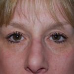 Blepharoplasty Before & After Patient #25068