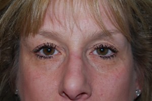 Blepharoplasty Before & After Patient #25068