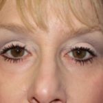 Blepharoplasty Before & After Patient #25068