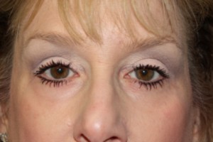 Blepharoplasty Before & After Patient #25068