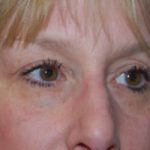 Blepharoplasty Before & After Patient #25068