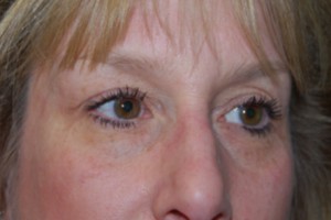 Blepharoplasty Before & After Patient #25068