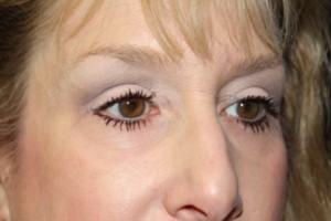 Blepharoplasty Before & After Patient #25068